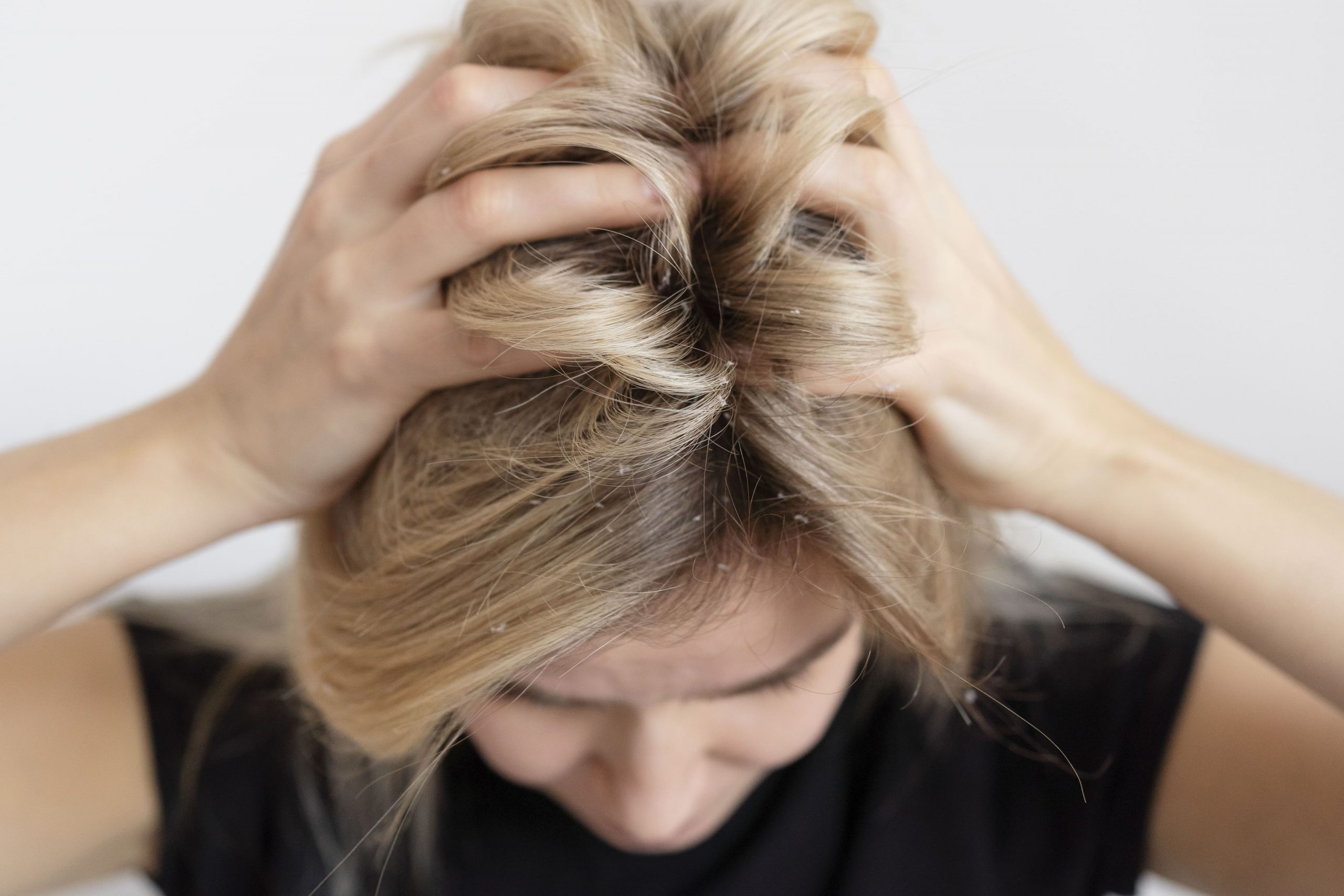 principales sintomas psoriasis en pelo