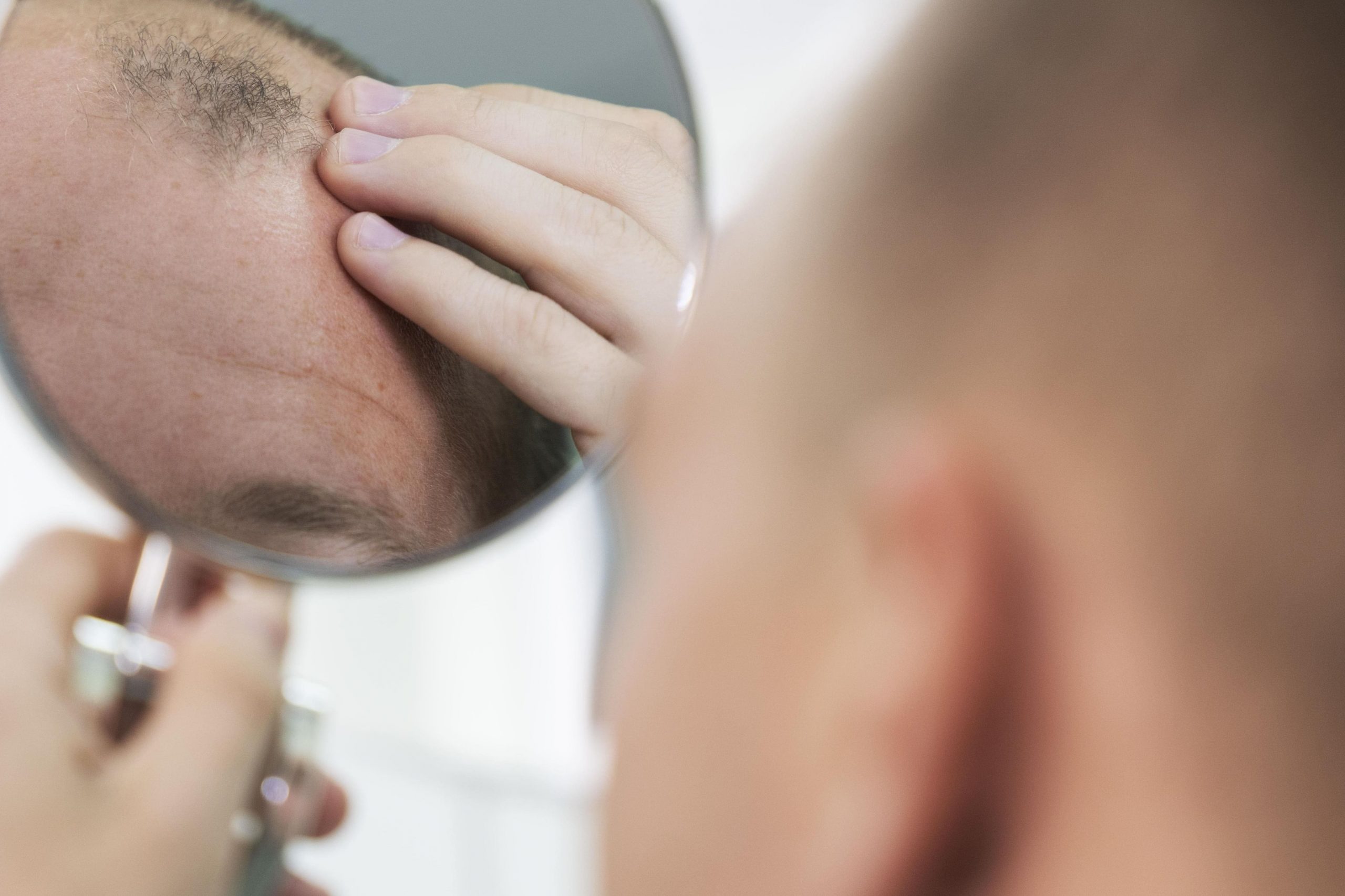 tratamientos alopecia frontal fibrosante en hombres