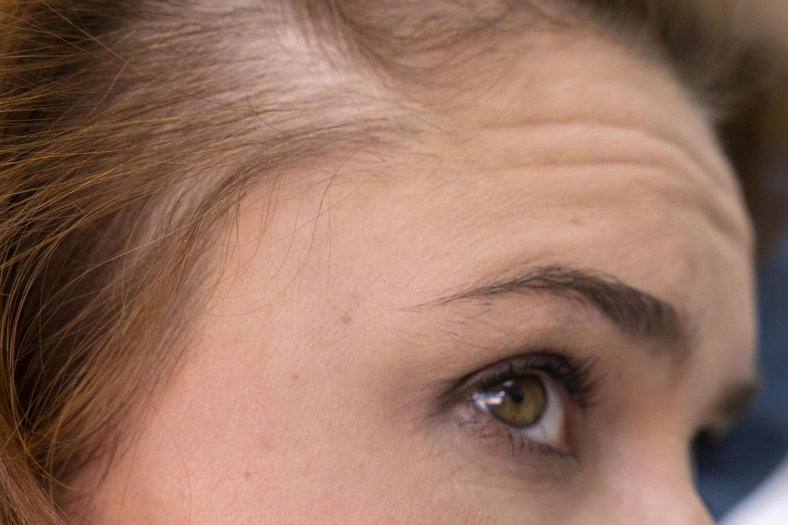 causas alopecia frontal fibrosante en mujeres